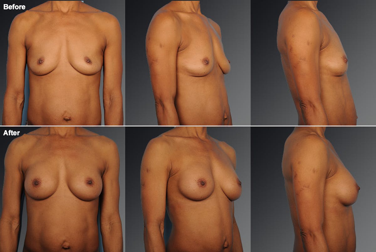 African American Breast Augmentation  Before & After Gallery - Patient 134859270 - Image 1