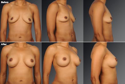 African American Breast Augmentation  Before & After Gallery - Patient 134859272 - Image 1