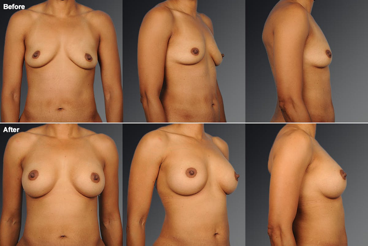 African American Breast Augmentation  Before & After Gallery - Patient 134859275 - Image 1