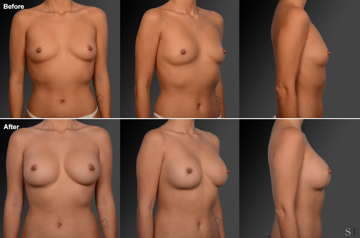 Asian Breast Augmentation Before & After Gallery - Patient 134859278 - Image 1