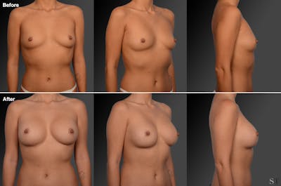 Asian Breast Augmentation Before & After Gallery - Patient 134859278 - Image 1