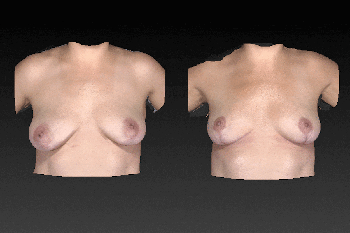 3D Imaging Before & After Gallery - Patient 134859282 - Image 1