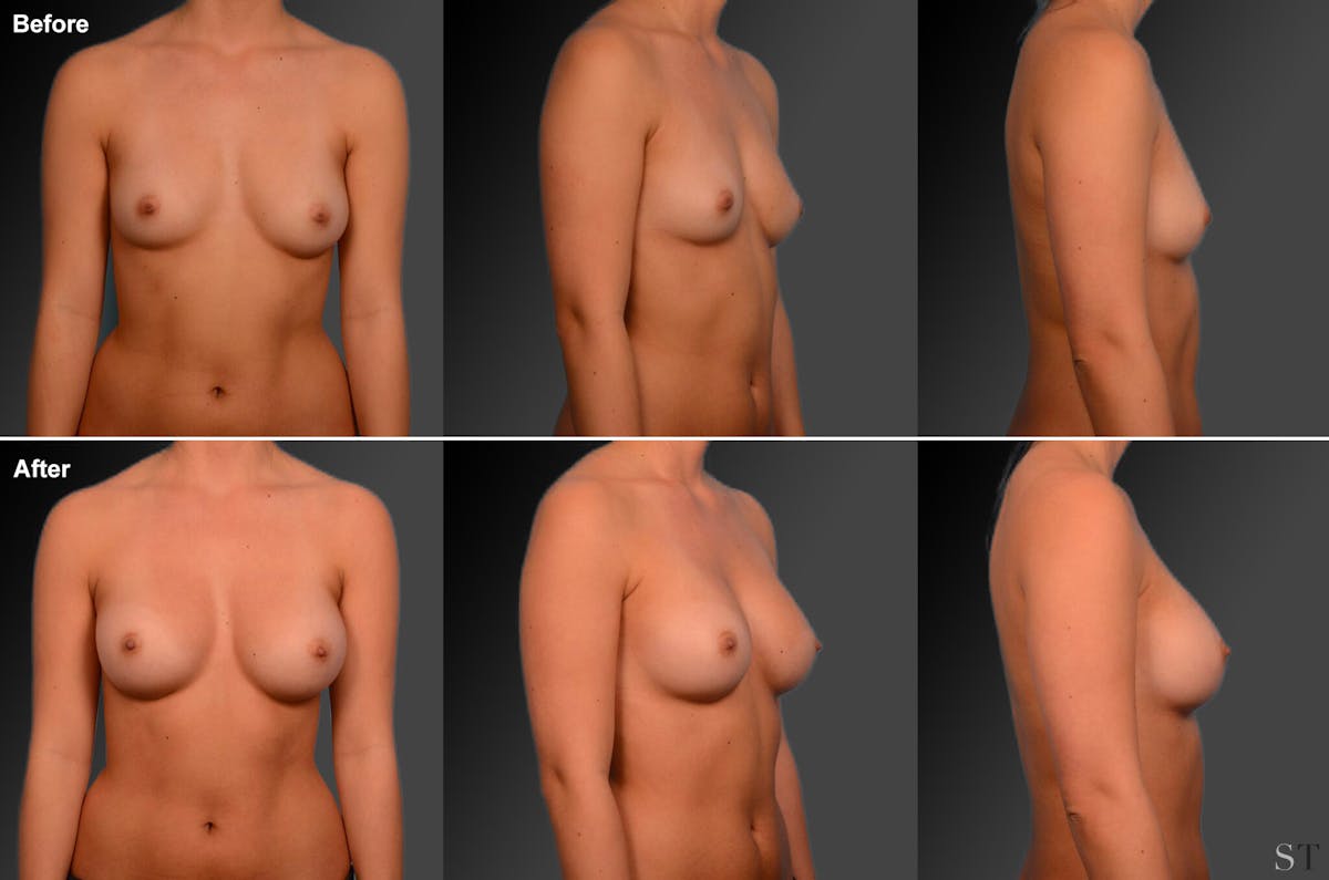 Asian Breast Augmentation Before & After Gallery - Patient 134859281 - Image 1