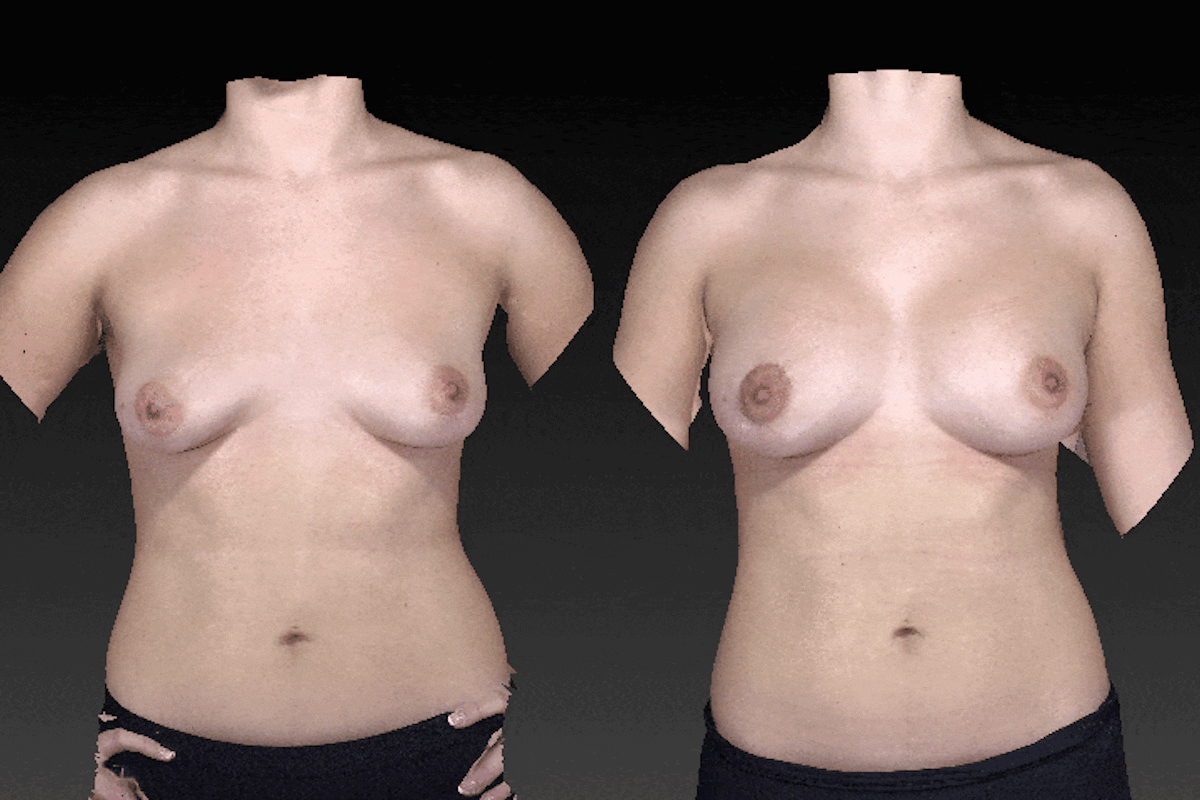 3D Imaging Before & After Gallery - Patient 134859285 - Image 1