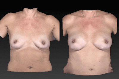 3D Imaging Before & After Gallery - Patient 134859294 - Image 1