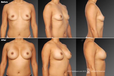 Latina Breast Augmentation  Before & After Gallery - Patient 134859304 - Image 1