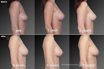 Long Term Before & After Gallery - Patient 134859331 - Image 1