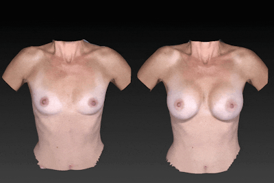 3D Imaging Before & After Gallery - Patient 134859350 - Image 1
