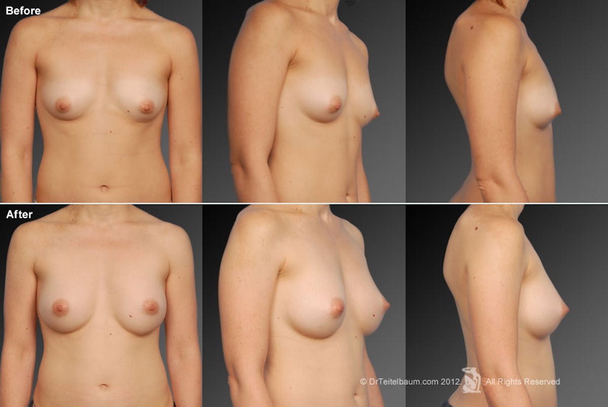 Tuberous Before & After Gallery - Patient 134859342 - Image 1