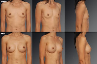 Asian Breast Augmentation Before & After Gallery - Patient 134859343 - Image 1