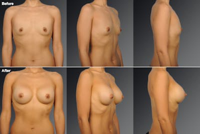 Asian Breast Augmentation Before & After Gallery - Patient 134859345 - Image 1