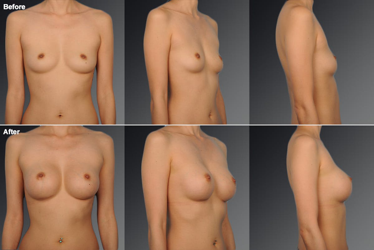 Asian Breast Augmentation Before & After Gallery - Patient 134859351 - Image 1