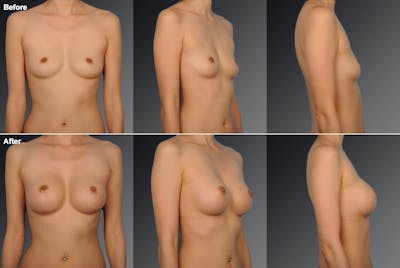 Asian Breast Augmentation Before & After Gallery - Patient 134859351 - Image 1