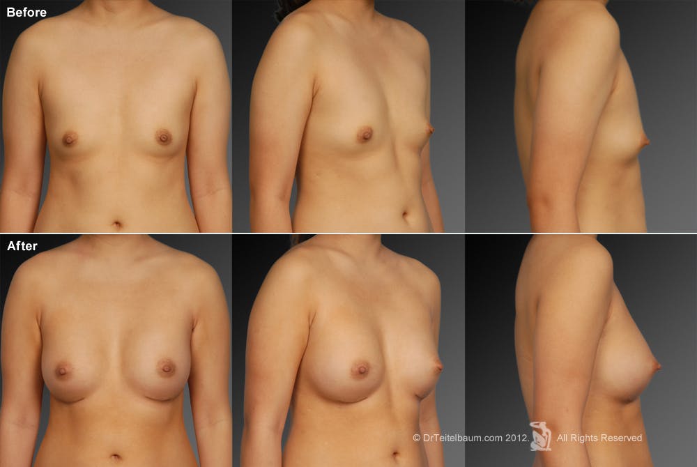 Tuberous Before & After Gallery - Patient 134859354 - Image 1