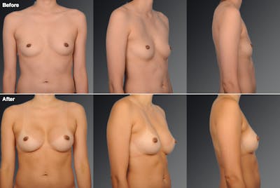 Asian Breast Augmentation Before & After Gallery - Patient 134859353 - Image 1