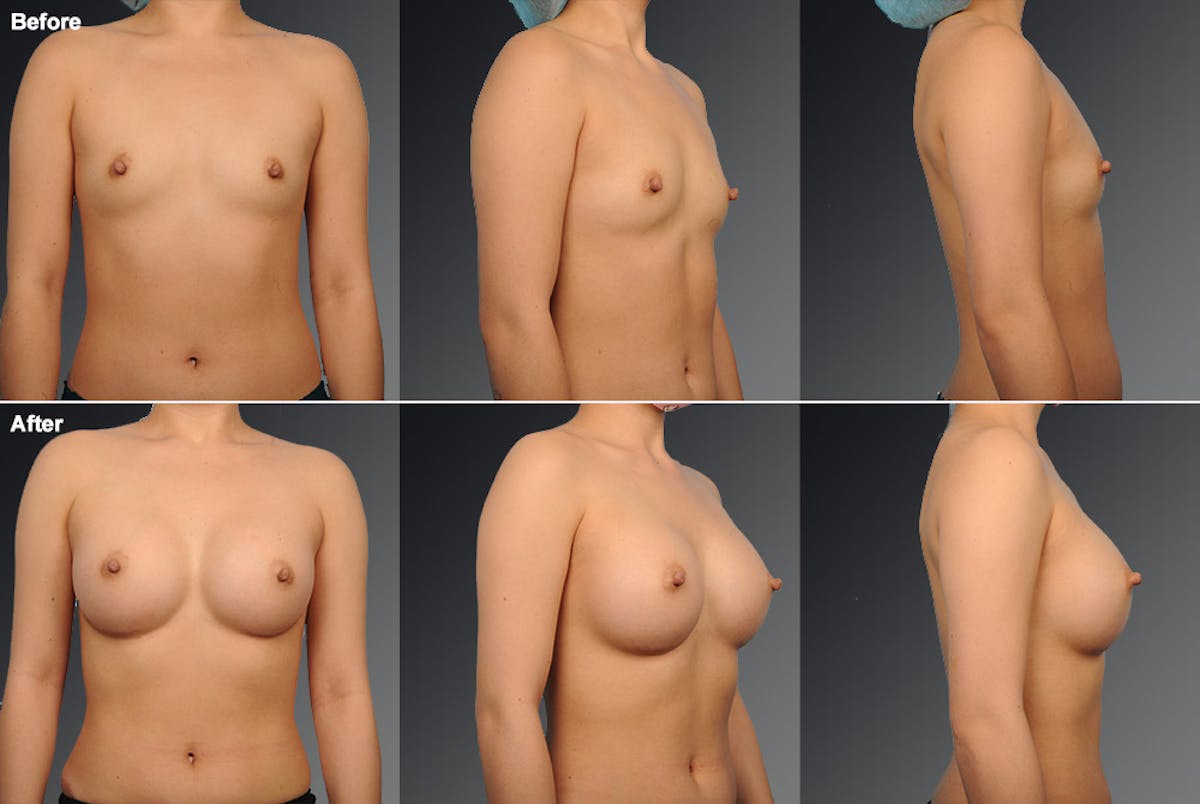 Asian Breast Augmentation Before & After Gallery - Patient 134859357 - Image 1