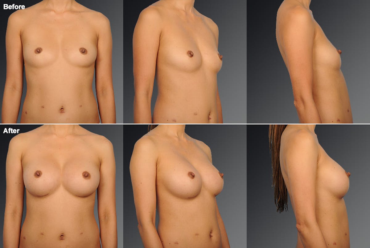 Asian Breast Augmentation Before & After Gallery - Patient 134859359 - Image 1