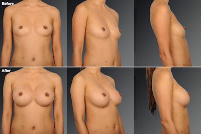 Asian Breast Augmentation Before & After Gallery - Patient 134859359 - Image 1