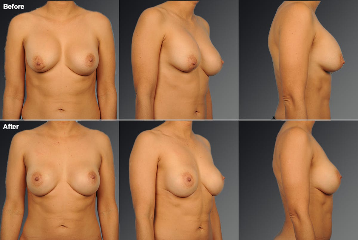 Capsular Contracture Before & After Gallery - Patient 134859364 - Image 1