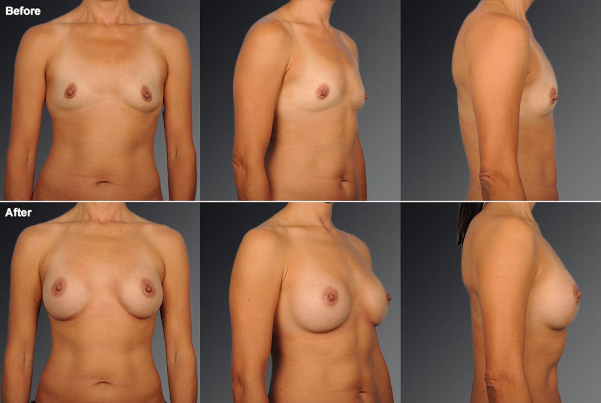 Asian Breast Augmentation Before & After Gallery - Patient 134859368 - Image 1