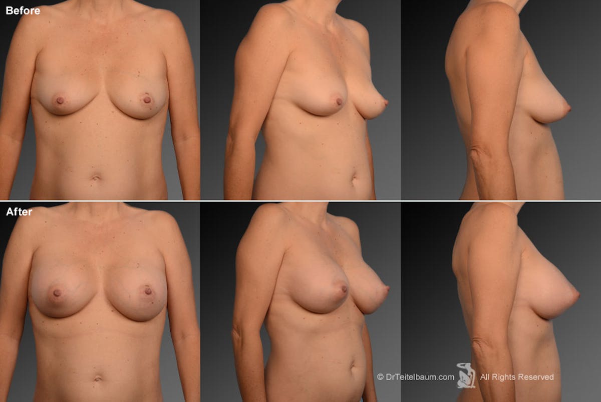Tuberous Before & After Gallery - Patient 134859370 - Image 1