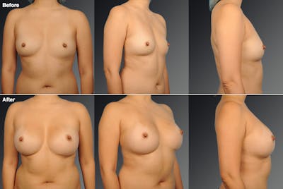 Asian Breast Augmentation Before & After Gallery - Patient 134859371 - Image 1