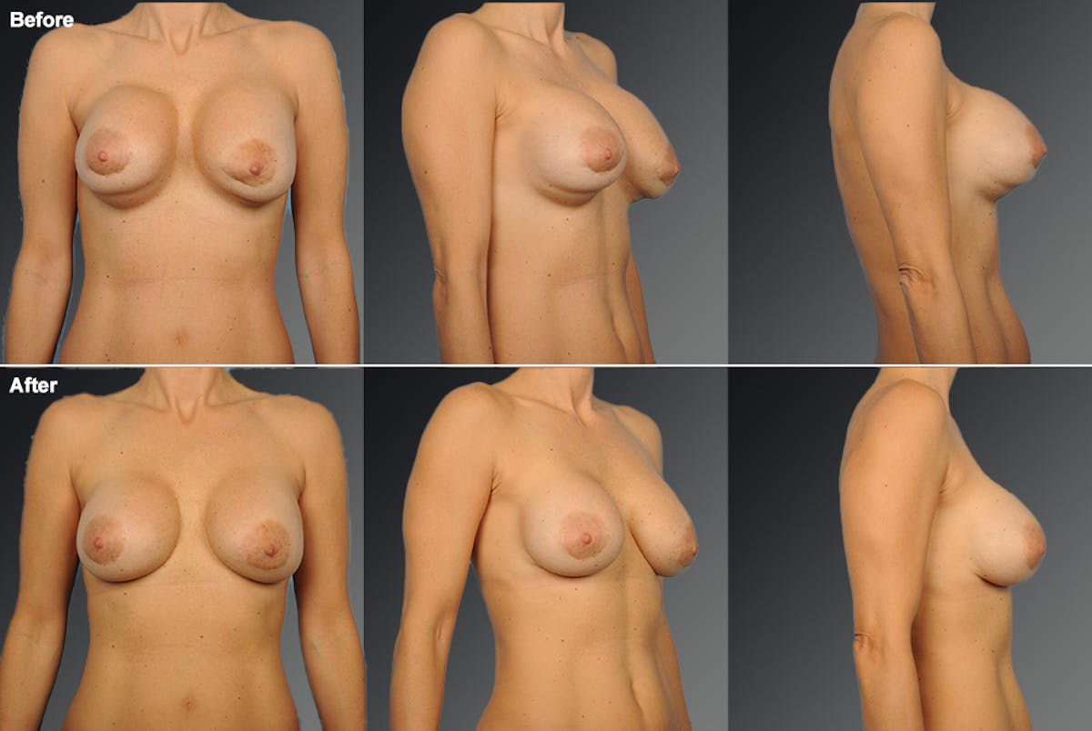 Capsular Contracture Before & After Gallery - Patient 134859375 - Image 1