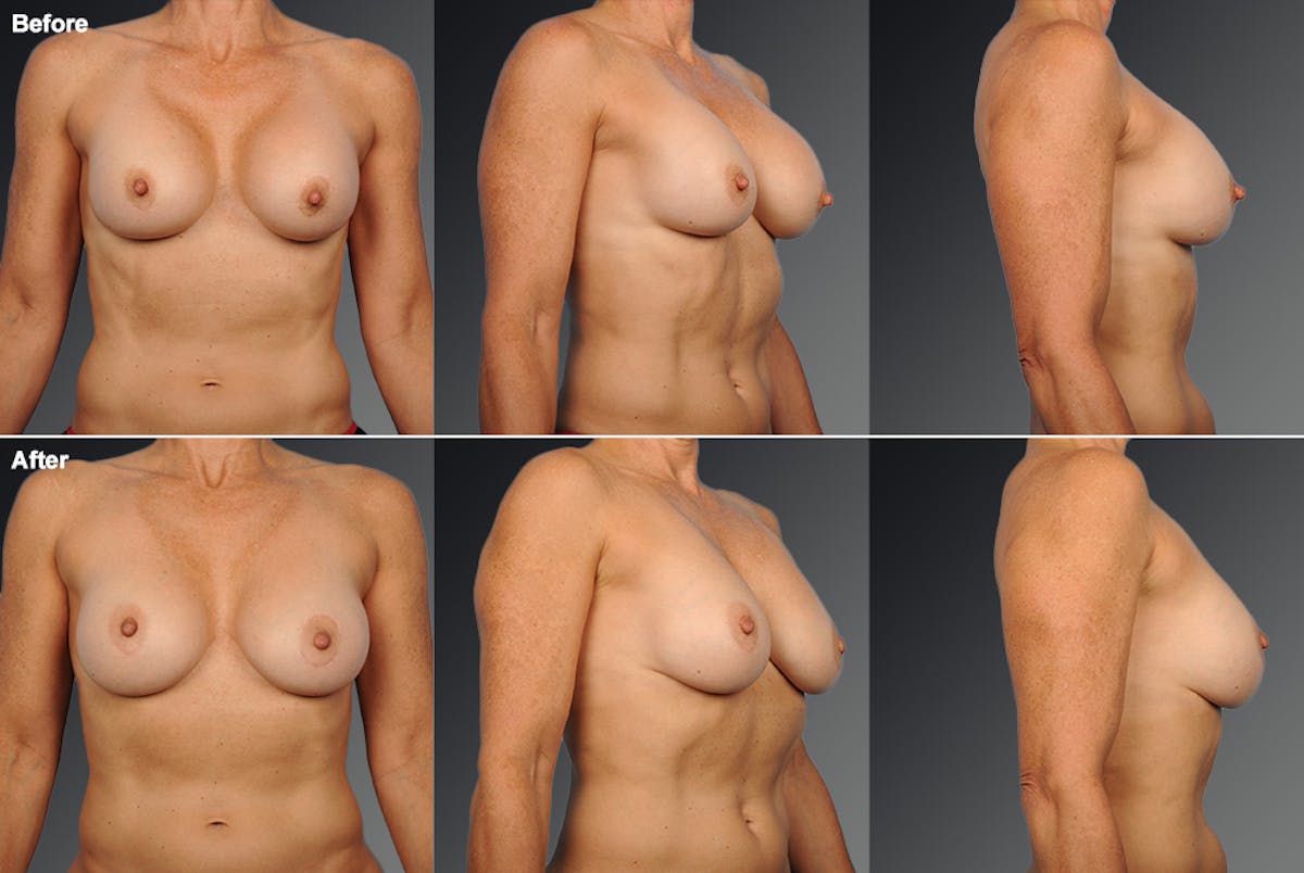 Capsular Contracture Before & After Gallery - Patient 134859377 - Image 1