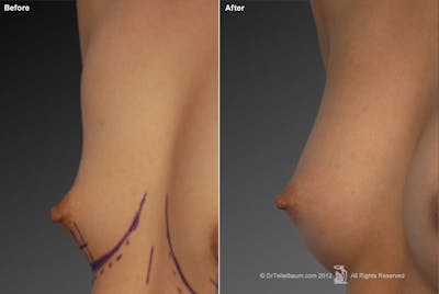 Tuberous Before & After Gallery - Patient 134859384 - Image 1
