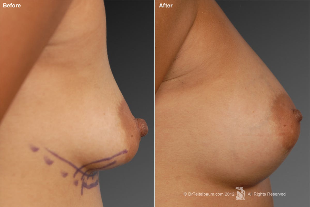 Tuberous Before & After Gallery - Patient 134859388 - Image 1