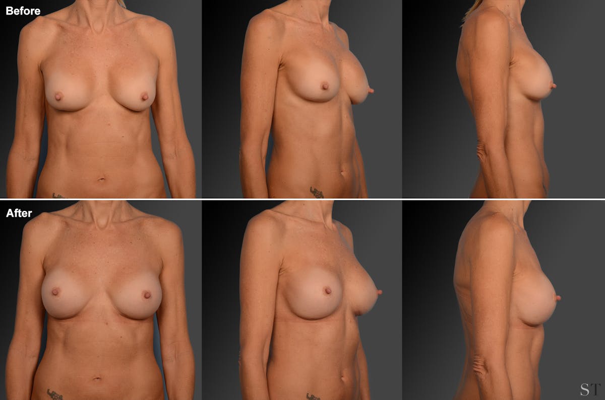 Capsular Contracture Before & After Gallery - Patient 134859391 - Image 1