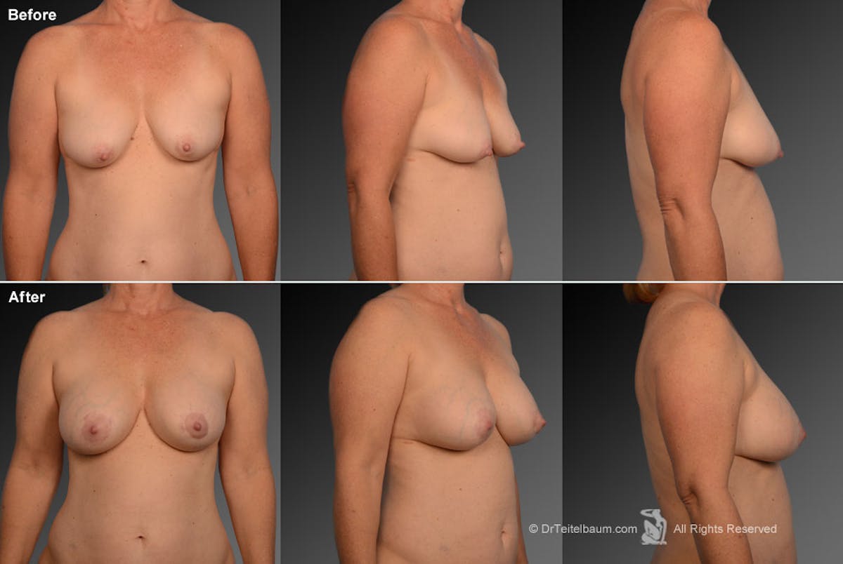 Tuberous Before & After Gallery - Patient 134859392 - Image 1