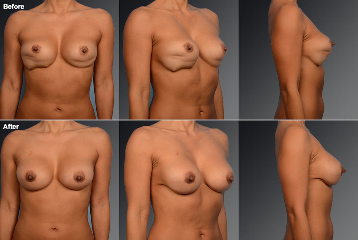 Capsular Contracture Before & After Gallery - Patient 134859408 - Image 1