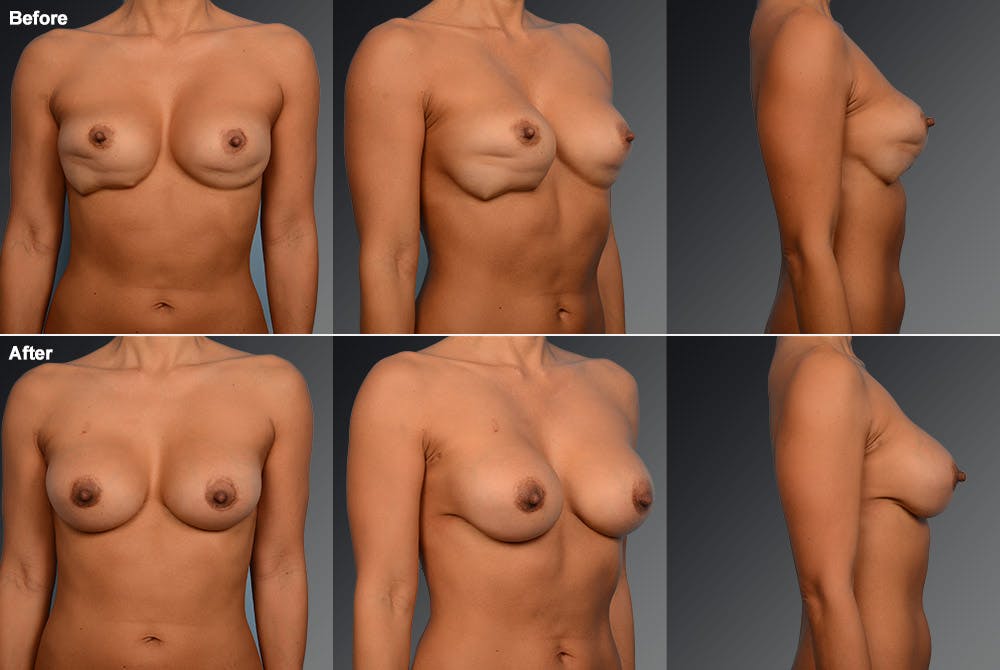 Capsular Contracture Before & After Gallery - Patient 134859408 - Image 1