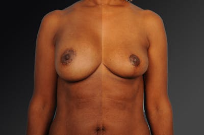 Explantation Before & After Gallery - Patient 134859411 - Image 1