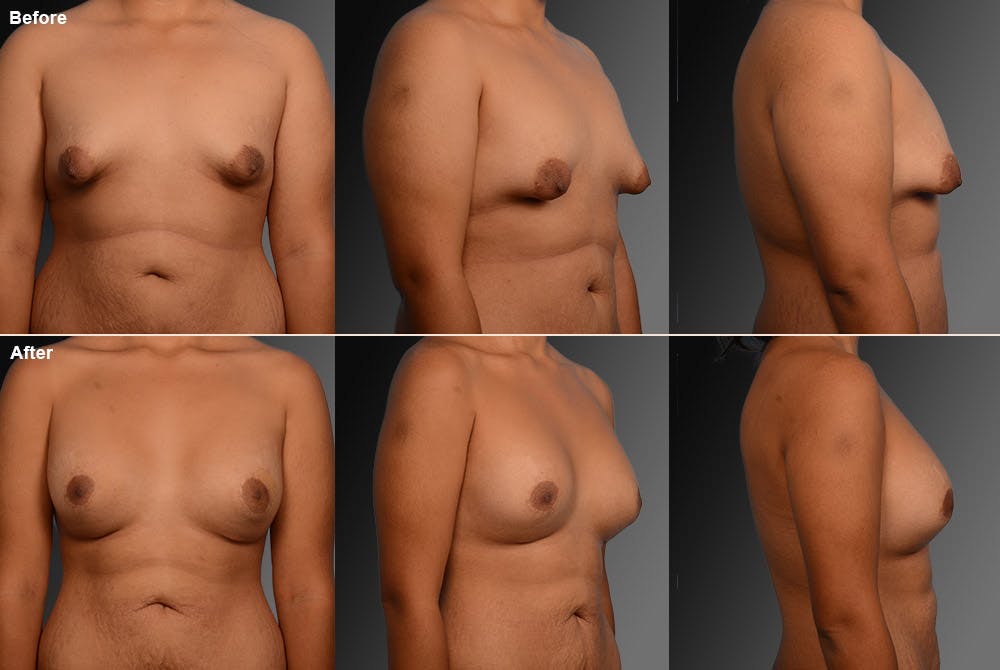 Tuberous Before & After Gallery - Patient 134859412 - Image 1