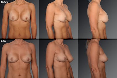 Capsular Contracture Before & After Gallery - Patient 134859422 - Image 1