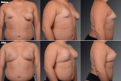 Tuberous Before & After Gallery - Patient 134859423 - Image 1