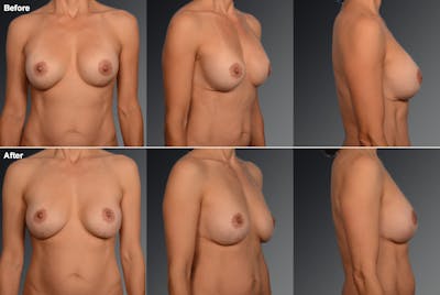 Capsular Contracture Before & After Gallery - Patient 134859428 - Image 1