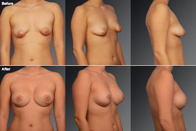 Tuberous Before & After Gallery - Patient 134859429 - Image 1