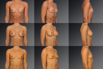 Explantation Before & After Gallery - Patient 134859433 - Image 1