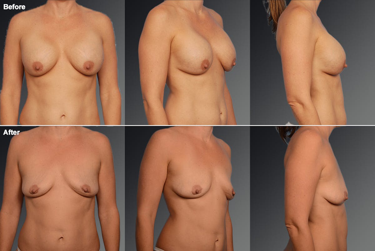 Explantation Before & After Gallery - Patient 134859449 - Image 1