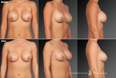 Capsular Contracture Before & After Gallery - Patient 134859465 - Image 1