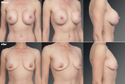 Explantation Before & After Gallery - Patient 134859466 - Image 1