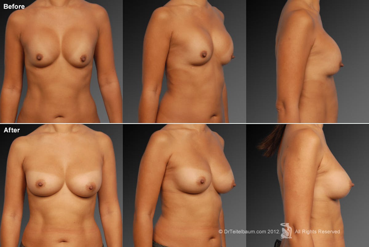 Capsular Contracture Before & After Gallery - Patient 134859481 - Image 1
