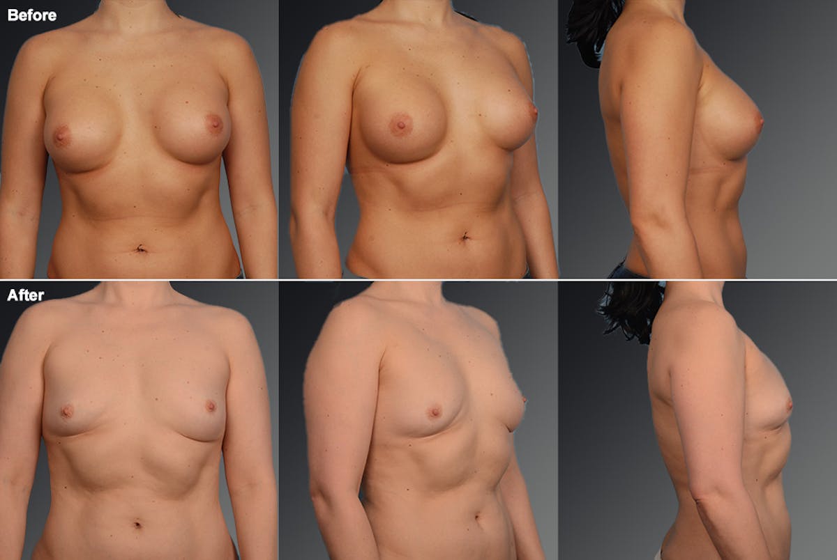 Explantation Before & After Gallery - Patient 134859489 - Image 1