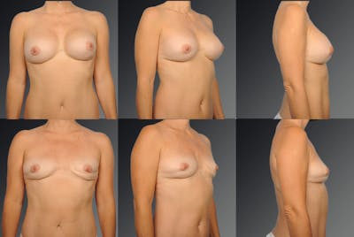 Explantation Before & After Gallery - Patient 134859539 - Image 1