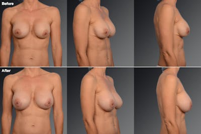 Strattice Alloderm Before & After Gallery - Patient 134859562 - Image 1