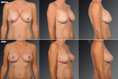 Explantation Before & After Gallery - Patient 134859569 - Image 1