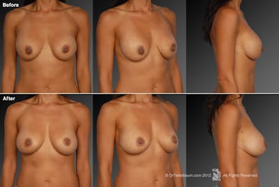 Capsular Contracture Before & After Gallery - Patient 134859575 - Image 1